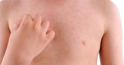 Deslușirea misterului erupțiilor cutanate: mai mult decât acnee