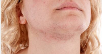 Alertă medicală! Firul de păr din barbă la femei poate ascunde boli grave! Ce trebuie să știi urgent!