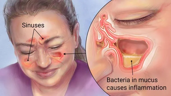 sinuses.jpeg