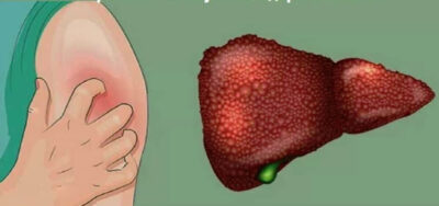Atenție! 7 simptome care îți arată că ficatul tău este în pericol!