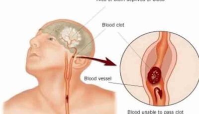 Atenție! Semnele unui accident vascular cerebral pe care nu trebuie să le ignori niciodată!