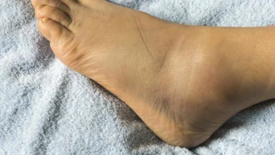 O singură gleznă umflată? Iată ce afecțiuni grave poți avea și când trebuie să mergi de urgență la doctor!