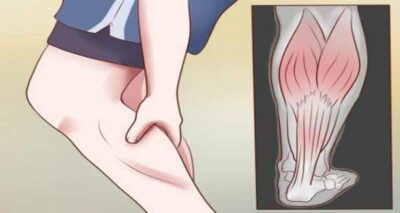 Cârceii: cauze, remedii naturale și prevenție pentru crampele musculare frecvente