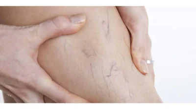 Varicele: cauze, simptome și remedii naturiste eficiente pentru picioare sănătoase