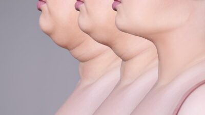 „Scapă de gușă în doar 7 zile cu aceste remedii naturale uimitoare – Numărul 4 te va surprinde!”