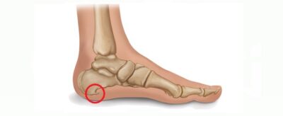 Remedii naturiste eficiente pentru pintenii calcaneeni: calmare și regenerare rapidă