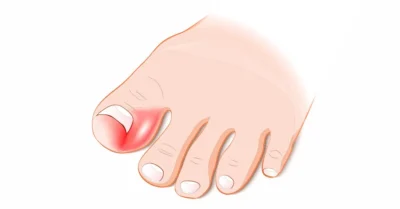 Cum să scapi rapid de unghia încarnată cu remedii naturale acasă, fără doctor