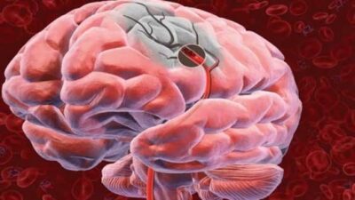 Cât de ușor se poate ajunge la accident vascular chiar de la o simplă ceartă? 10 lucruri care te țin departe de un AVC