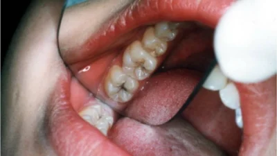 De ce faci carii chiar dacă te speli pe dinți? 10 trucuri naturale care îți pot salva zâmbetul!