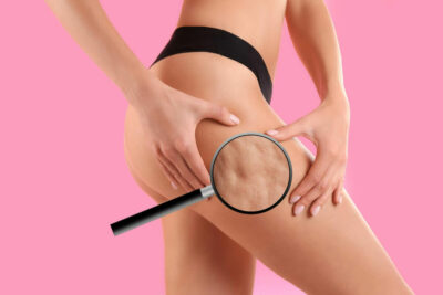 Uite cum scapi rapid și natural de celulită cu un ingredient la care nimeni nu s-ar fi așteptat!