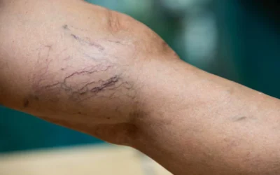 Nu o să-ți vină să crezi cum 3 plante simple pot elimina picioarele grele și varicele în doar 14 zile!