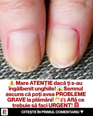 Șocant! Unghiile galbene i-au salvat viața unui bărbat după ce medicii au descoperit o tumoare uriașă ascunsă!