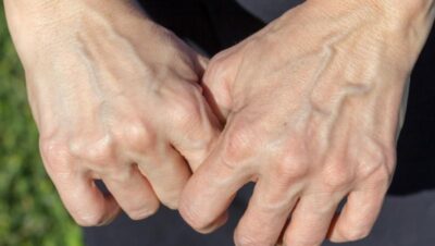 Ai venele vizibile la mâini? Medicii avertizează: Când devin un semnal de alarmă pentru o boală gravă