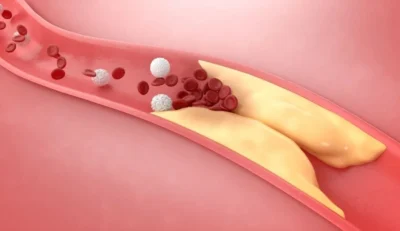 Aruncă pastilele de colesterol! Leguma pe care o ai în casă îți curăță arterele mai bine decât orice medicament
