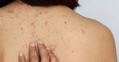 Ai pete maronii pe piele? Ingredientul banal din bucătăria ta care le șterge definitiv peste noapte