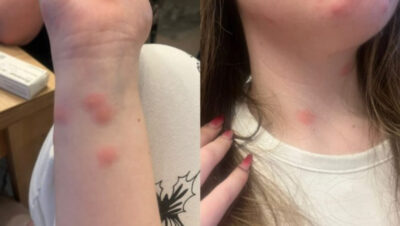 COȘMAR într-un tren CFR! O tânără a ajuns DIRECT la spital după o noapte la cușetă, MÂNCATĂ de ploșnițe din cap până-n picioare!