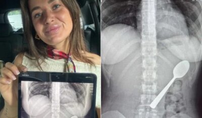 A înghițit o lingură de 17 cm, dar i-a fost rușine să îi spună iubitului! Ce a simțit tânăra în stomac e terifiant