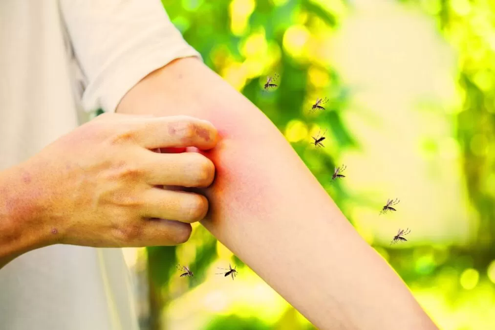 Ai fost înțepat de țânțari? Trucul genial din bucătărie care oprește mâncărimea instant