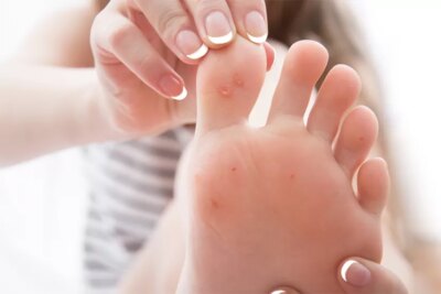 Pui asta pe negi și scapi de ei! Ingredientul din bucătărie care face minuni pentru piele