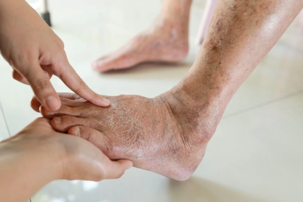 Semnele de la picioare care pot trăda o afecțiune a ficatului. Ce spun medicii